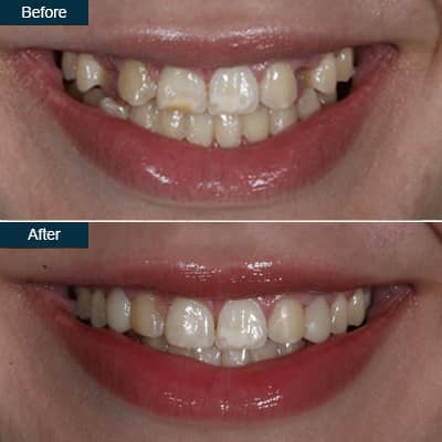 dental-bonding-before-after-teeth