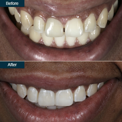dental-bonding-before-after-teeth2