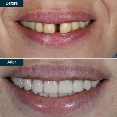 implant_denture_before_after-2