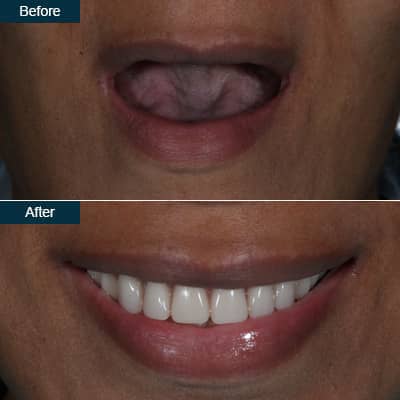 implant_denture_before_after-3