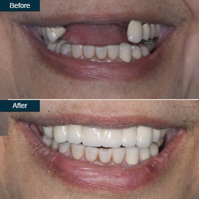 implants-before-and-after-teeth