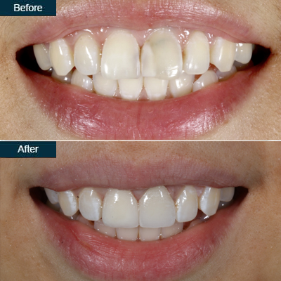 veneer_after_before-1