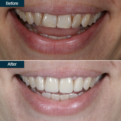 veneers_after_before-2