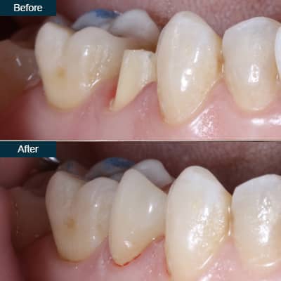 dental bonding before after teeth crown