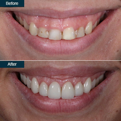 Dental Veneers before and after