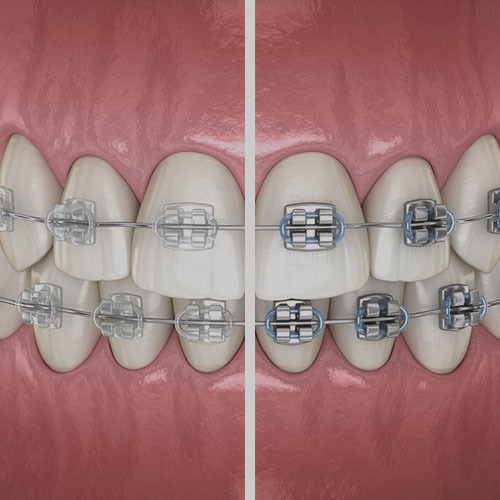 Clear vs. Metal Braces