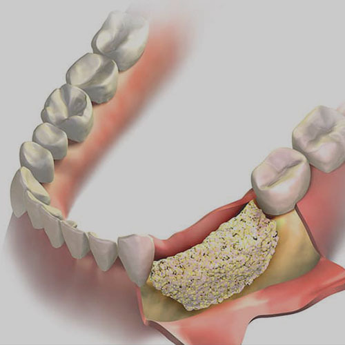 Dental Bone Graft