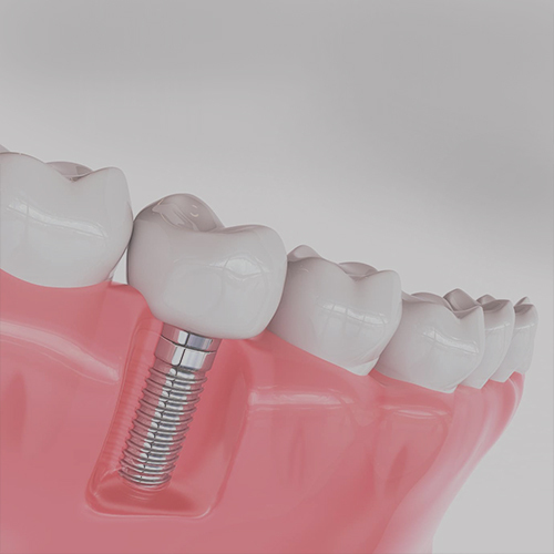 Dental Implant