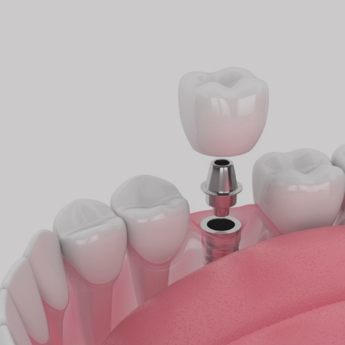 Dental Implant