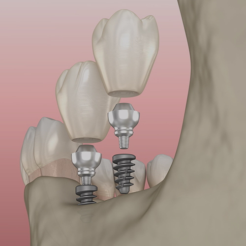 Mini Dental Implants