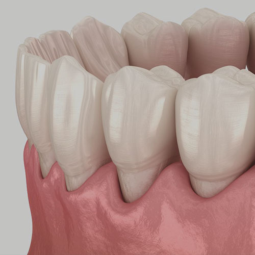 Periodontal Disease