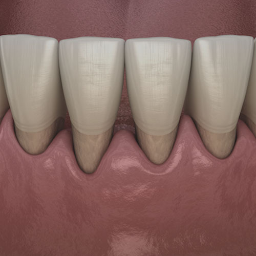 Periodontal Disease