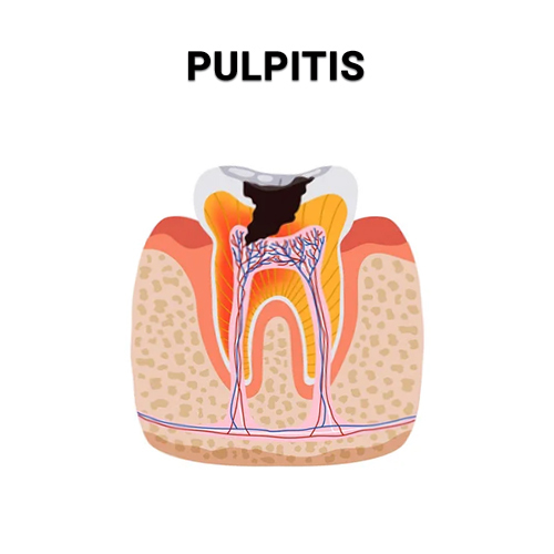 Pulpitis