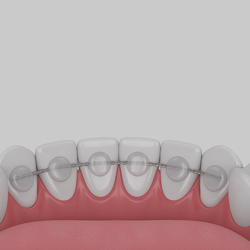 Retainer for Teeth Straightening