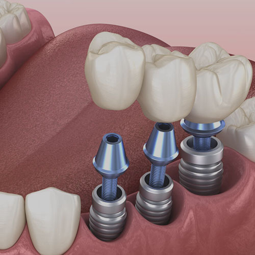 Same-Day Dental Implants