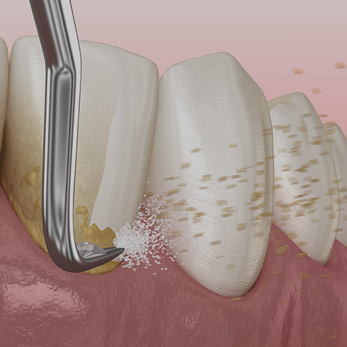 Teeth cleaning