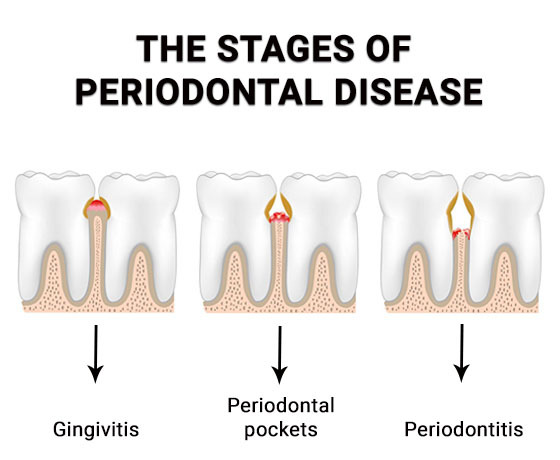 The stages of Periodontal Disease