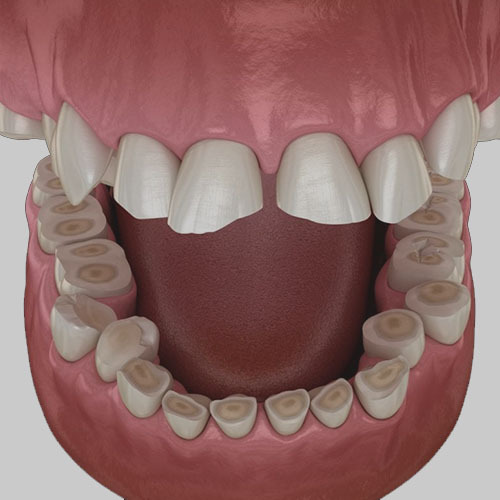 Enamel Erosion Treatment Tooth Enamel Restoration Family Cosmetic