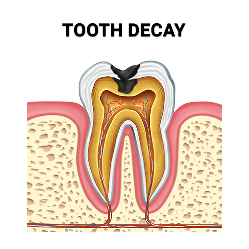 Tooth decay