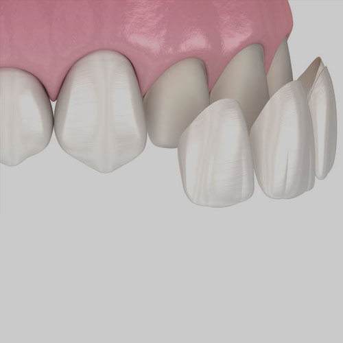 Veneers for Small Teeth