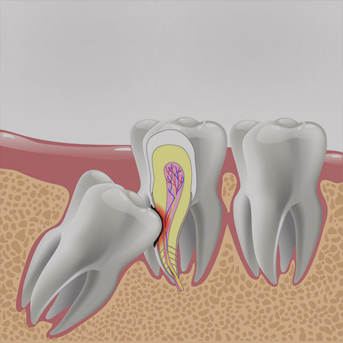 Wisdom Tooth