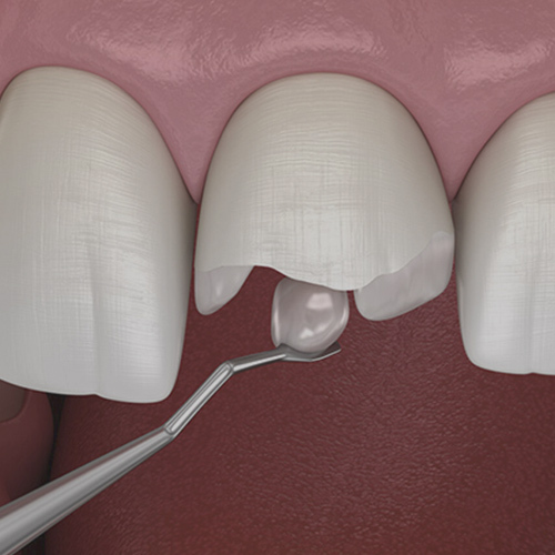 Throbbing Tooth Pain Treatment Top Rated Dentists Brooklyn NY throbbing-tooth-pain-treatment-top-rated-dentists-brooklyn-ny