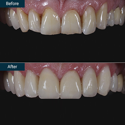 Veneers before after