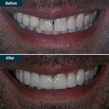 Before and after crowns