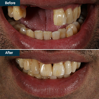 Before and after dental impacts
