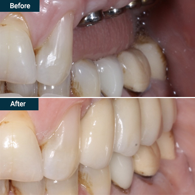 Before after dental implants