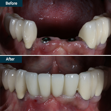 Dental Implants & Crowns Before and After