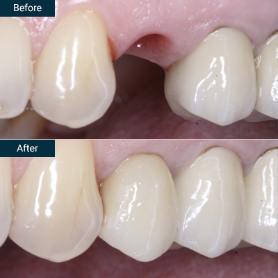 Before after implant crowns before after