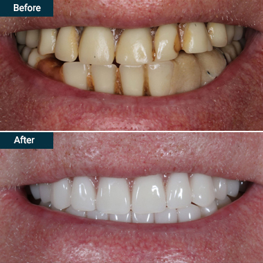 Before after over dentures