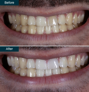 before after internal-tooth whitening