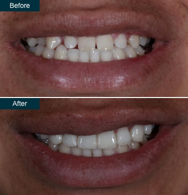 before after small teeth to larger teeth