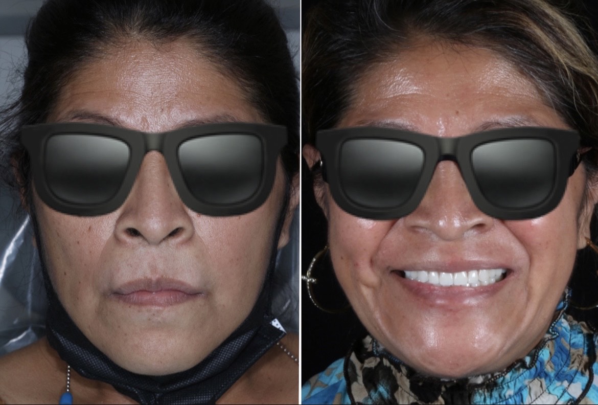 Before and after of implant over dentures