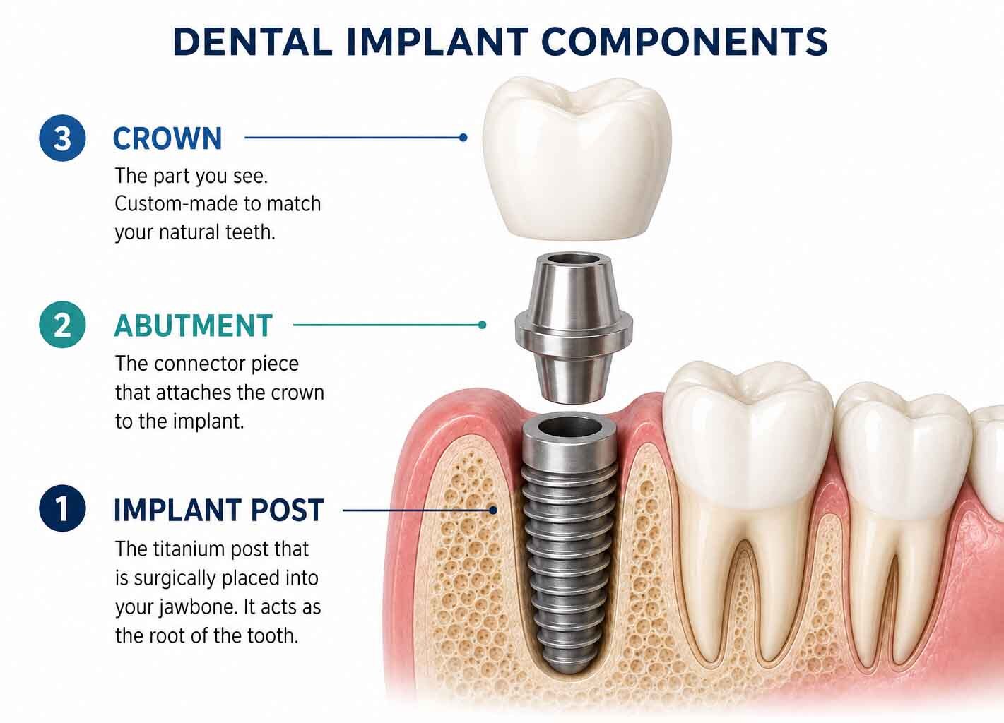 Dental implant post, abutment, and crown components explained for patients comparing dental implant cost in Brooklyn.